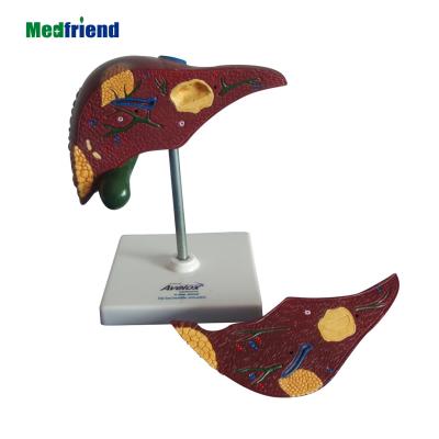 China Liver Cancer Human Pathological School Model Patient Care Demonstration Liver Display Tool Medical Teaching Laboratory Equipment for sale