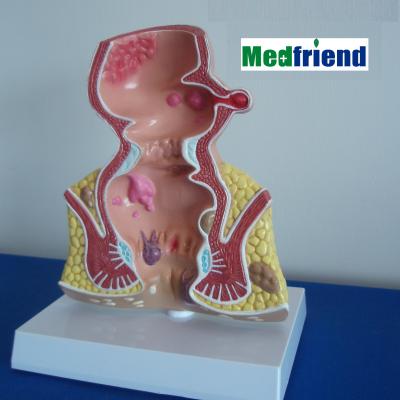 China Patients Care Familiar Disease Demonstration Factory Price Model With Pathological Rectum Rectum Model for sale