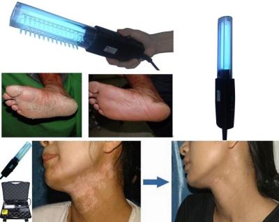 China Psoriasis Uvb 311nm Phototherapy 200V Uvb Vitiligo Lamp for sale