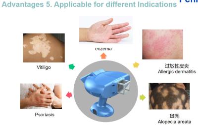 China Homeuse 308NM Excimer Light Treatment Treat Vitiligo / Psoriasis for sale