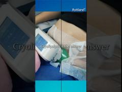 How many areas can cryolipolysis