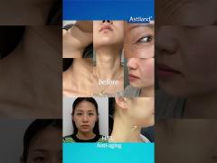 Remarkable effects of HIFU｜Before & After