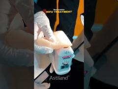 witness the non-invasive lifting power of HIFU