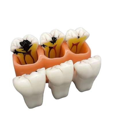 China Dental Model Caries Decomposition Human Pathology Model 4 Education Time Caries for sale