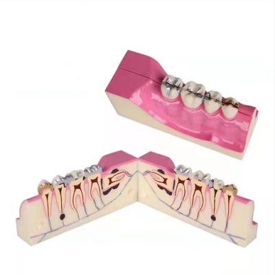 China Durable Adult Right Tooth Tissue Decay Lower Posterior Dental Anatomical Model for sale