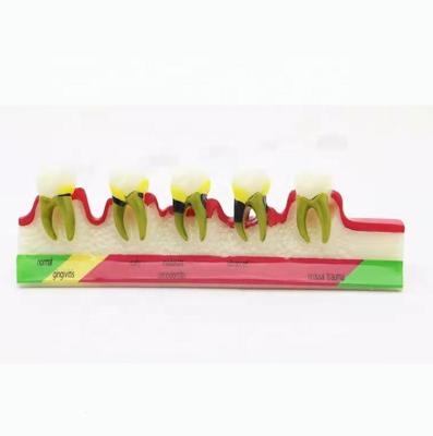 China Education Teaching Teeth Model Dental Resin Restoration Model Dental Study Model for sale