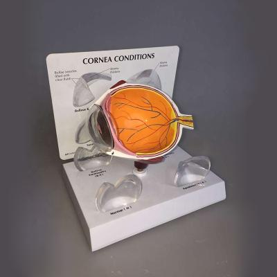 China Long lasting eyeball disease, corneal disease model for sale