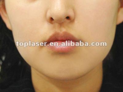 China Erbium Glass Fractional Laser, 1550nm Fractional/Aging Spots/Wrinkles Removal for sale