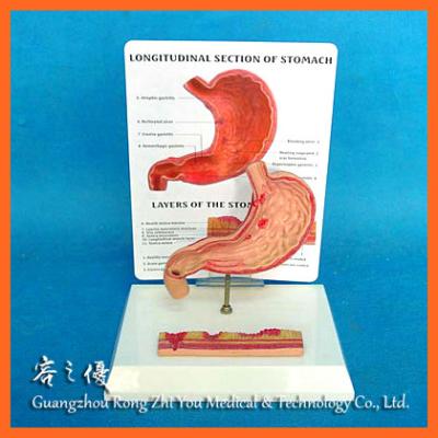 China R100208 Realistic Human Anatomical Gastric Gastric Ulcer Human Simulation Demonstration Medical Model for sale