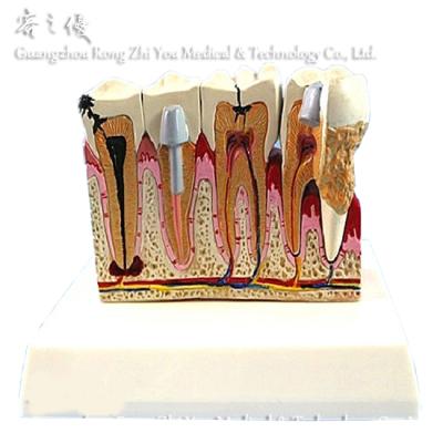 China Realistic Simulation R080119 Human Pathological Teeth Anatomy Dental Care Model Teaching Use for sale