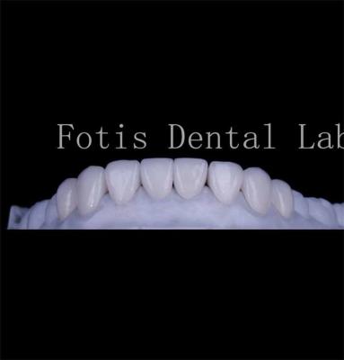 China Con una textura lisa y duradera, cubre los dientes con carillas naturales en venta