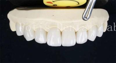 China 0.3-0.5mm keramische gelamineerde tanden valse tanden veneers met kleefbindingscement Te koop