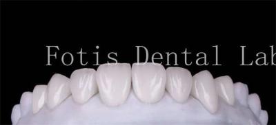 China Polir acabamento cosmético de revestimento de dentes para um sorriso bonito à venda