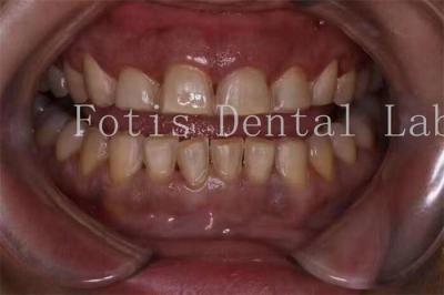 Chine Fabrication personnalisée de placages pour dents en porcelaine avec une surface lisse à vendre
