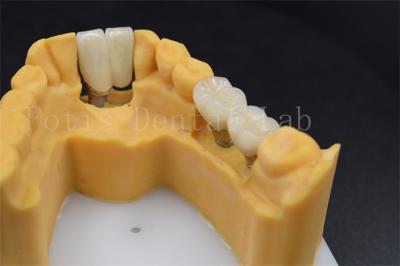 China Restauración dental personalizable Implante de reemplazo de corona Varios tamaños en venta