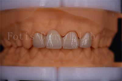 China FDA Certified Digital Crowns Bridge Dentrues Design  Customizable Size for sale