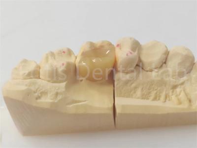 Cina Infissi dentistici di precisione e onlay per restauri precisi e duraturi in vendita