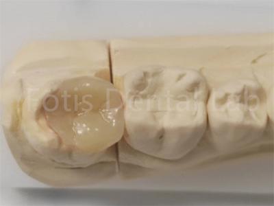 Cina Infissi estetici e infissi in odontoiatria per riempimento indiretto e restauro dei denti in vendita