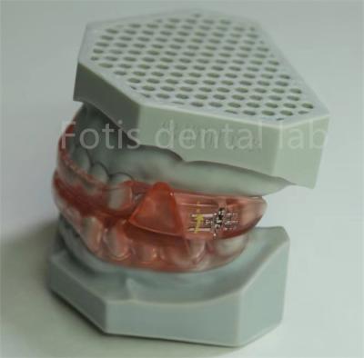 China Affordable Dental Lab Hyrax Expander Orthodontic Retainer Easy To Clean And Maintain for sale