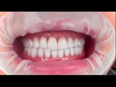 Our zirconia effect in the mouth