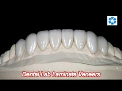 customization dental lab laminate veneers with high stain resistance and strength