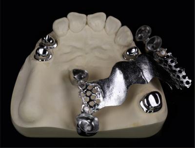 China Telescope Metal Crown And Bridge For Dental And Orthodontic for sale