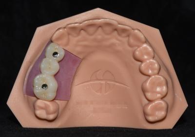 China Implant Porcelain Fused To Zirconia Implant Crown Bridge Highly Aesthetic for sale