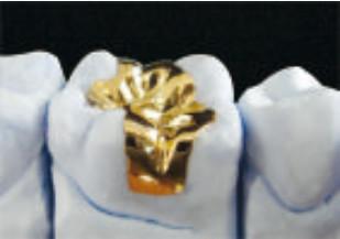 China Fit Excellent Dental Gold Onlay CE en FDA Gold Inlays en Onlays Te koop