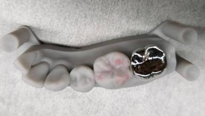 China Full Metal Non Precious Crown Implant PFM Crown And Bridge Professional for sale