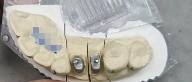 China Metallic / Natural Ti Base Crown Post Core Titanium Crowns For Teeth for sale