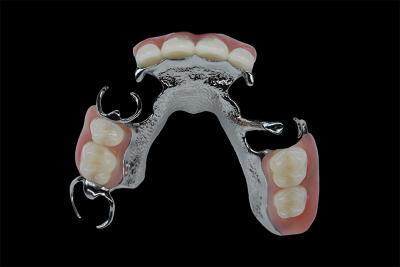 China Customizable Removable Dentures Titanium Framework Dental Metal Framework for sale