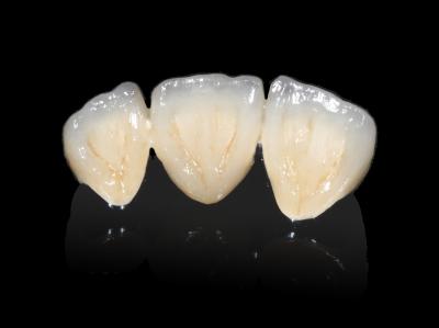 China Implantaten Tandheelkundige PFM-brug Niet-prijswaardige CAD CAM PFM-kroon Te koop