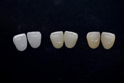 China Highly Aesthetic Zirconia Veneer Long Lasting Zirconia Emax Veneers for sale