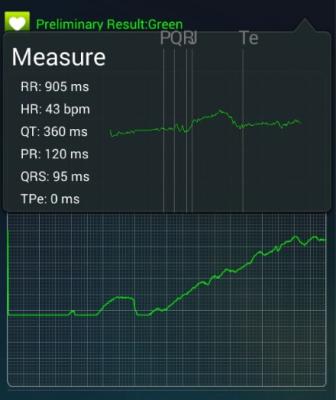 China Wecardio UN 3. ECG Event Recorder-Telemed Bluetooth EKG  Mobile ECG Devices for sale