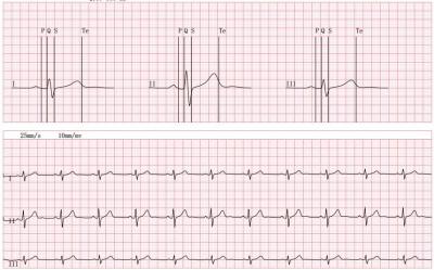 China Wecardio 3-Leads Cardiac Event Recorder Bluetooth ECG Monitor Mobile EKG Telemetry HRV for sale