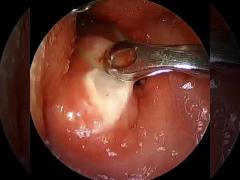 ENT RF Plasma Surgical Machine For Turbinate reduction,andenoidectomy&Tonsil&Throat Surgery