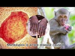 Symptoms of monkeypox