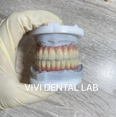 Cina Corone dentali digitali a bocca piena e ponte PFM traslucidità in vendita