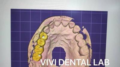 China Design de coroa dental de contorno completo Zirconia CE FDA Certificado à venda