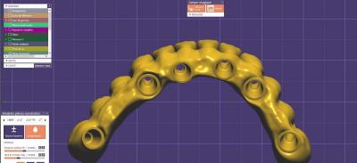 China Completa Anatomia Dental Design Implante Coroa ponte parafuso retido à venda