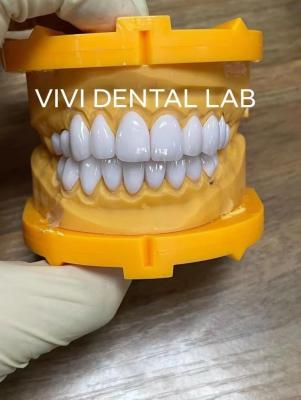 China Super Branco E Max Veneers Laminado Dental Profissional Alta Estética à venda