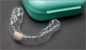 Cina Dental Stabile denti Ortodontico Retainer Professionale Chiaro Essix Retainer in vendita