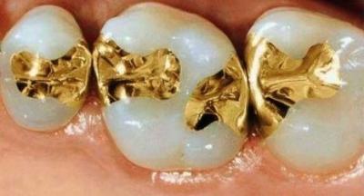 Cina Infissi dentali delicati, corone onlay, 74% di oro, infissi e onlay in vendita