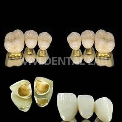 China La corona de oro amarillo de alto premio Nobel es una corona de dientes PFM libre de níquel en venta