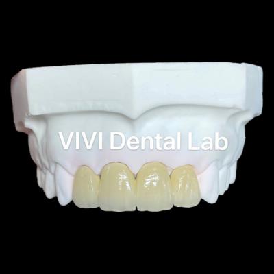 China Coroas de zircônio PFZ Coroa de zircônio de porcelana Coroa dentária à venda