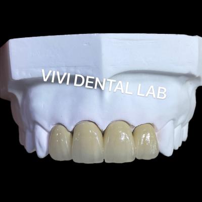 China Dental Lab Metal Ceramic Crown PFM Crown High esthetics Perfect fit for sale