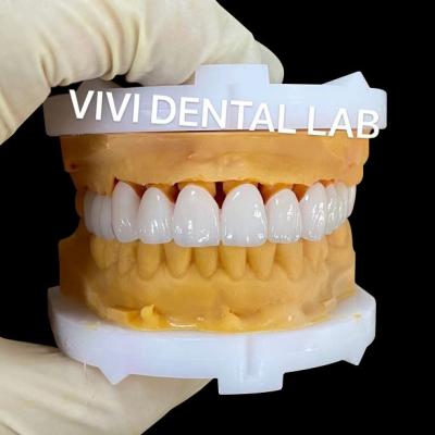 China CE Dental Tooth Crowns Nickel Beryllium Free VIVI Dental Laboratory for sale