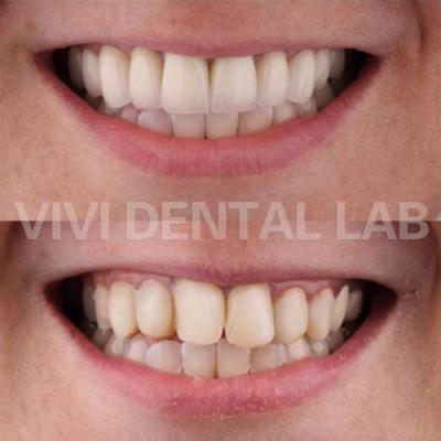 China NI Be Free Dental Crowns In Mouth Professional FDA Certified for sale