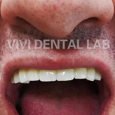 China Dental Digital Full Zirconia Bridge In Mouth Professional Stable for sale