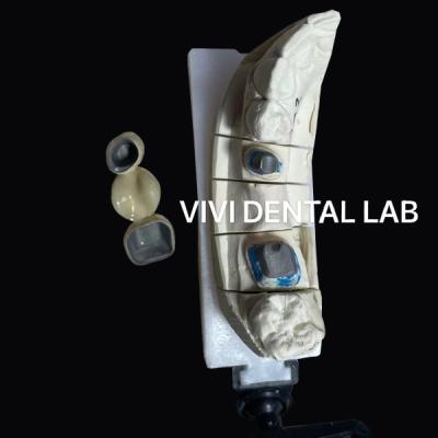 China VIVI Post Core And Crown Ni Be Free dental restoration for sale